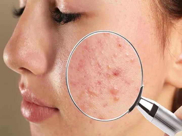 What are blind pimples