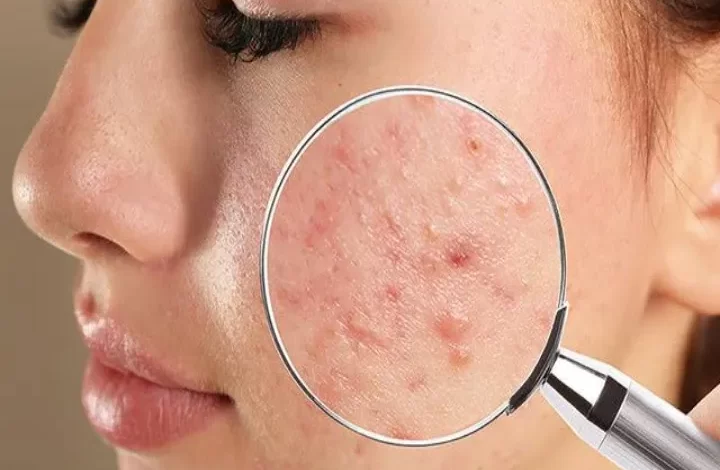 What are blind pimples